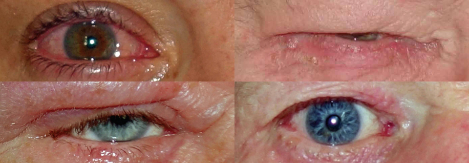Allergien am Auge erkennen und behandeln
Reaktion auf Haarspray (oben links), Holzschutzmittel (oben rechts), Fischprodukte (unten rechts) und eine bakteriell superinfizierte Blepharitis (unten links).