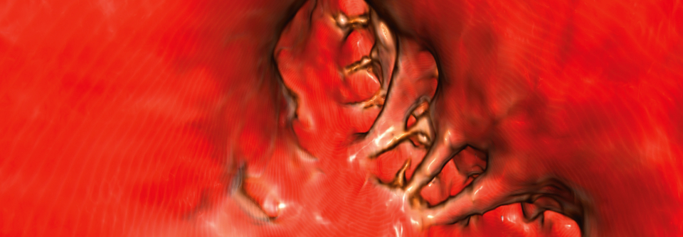 Ansicht aus dem linken Atrium nach Verschluss des Vorhofohrs. 3D-Darstellung basierend auf einer CT-Angiographie.