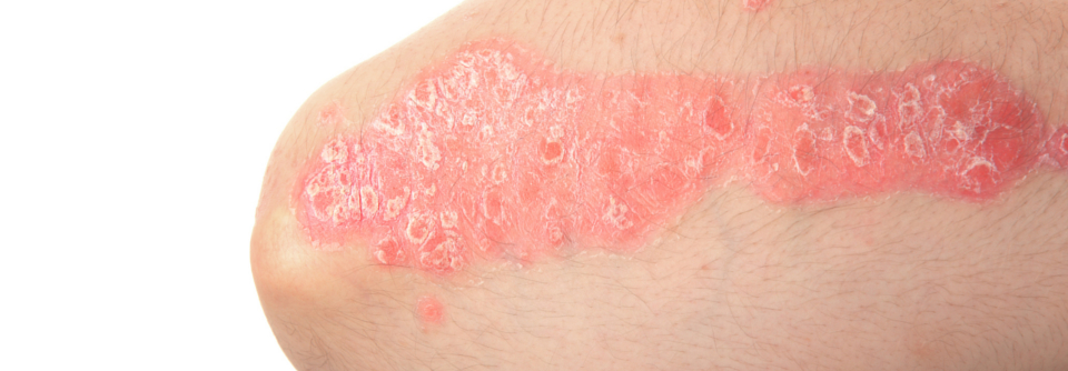 Erstdiagnose nein, Verlaufskontrolle ja – das gilt in der Telemedizin zumindest für die beiden großen Bereiche Psoriasis und atopische Hauterkrankungen.