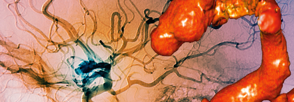 Aneurysma in der Halsschlagader einer 28-jährigen Patientin in 2D- und 3D-Darstellung.