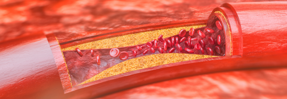 Laut einer Studie lassen sich atherosklerosebezogene Biomarker für Entzündungen und Thrombosen mit dem Wirkstoff deutlich reduzieren. 