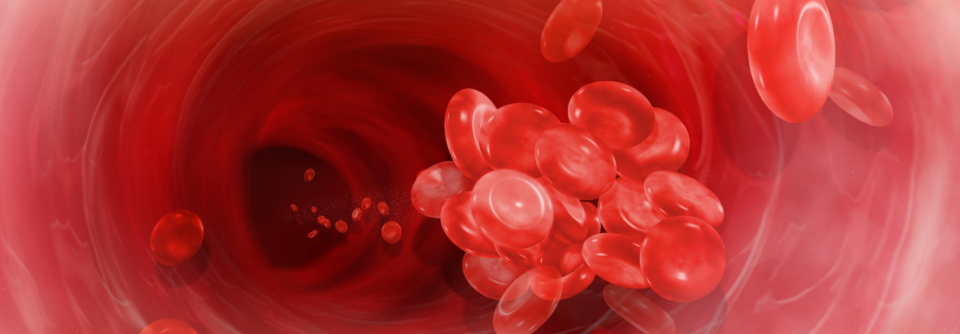 Zu den Risikofaktoren für eine superfizielle Venenthrombose zählen neben Varizen höheres Alter, Immobilisierung und Transfusionen.