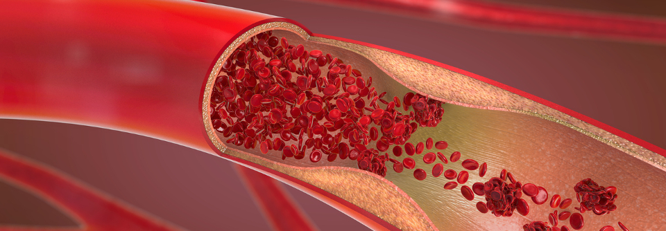 Eine entscheidende Rolle  für die Erholung nach einer Thrombektomie könnte die Anzahl der Versuche zur Entfernung der Blutgerinnsel spielen.
