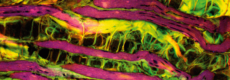 Charakteristisch für die Muskeldystrophie ist, dass der Muskel (lila) durch Fettgewebe (schwarz) ersetzt wird.
