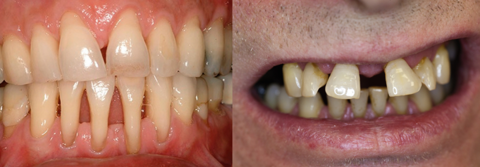 Eine Parodontitis kann schnell fortschreiten. Bei diesem Patienten (links) hatte sich das
Zahnfleisch innerhalb weniger Monate weit zurückgezogen. Im späten Stadium kann
es zur Zahnwanderung (rechts) kommen.
