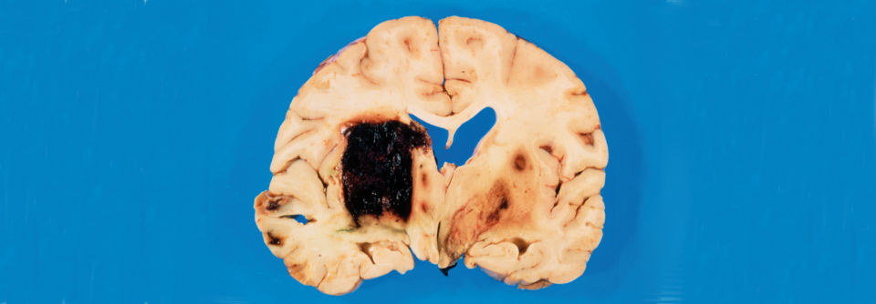 Intrazerebrale Hämorrhagien sind meist durch Hypertonie oder Atherosklerose bedingt. Sie führen zu neurologischen Defiziten, Kopfschmerz und Übelkeit.