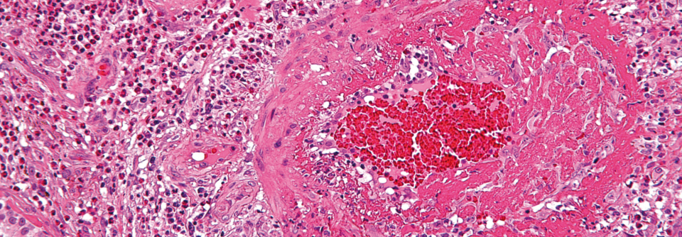 Zahlreiche Eosinophile umzingeln ein Blutgefäß von einem Patienten mit Churg-Strauss-Syndrom.