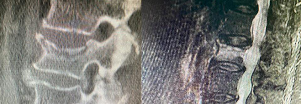 Die Bildgebung zählt zu den Bausteinen der Osteoporose-Diagnostik. Mitunter finden sich Wirbelkörperfrakturen.