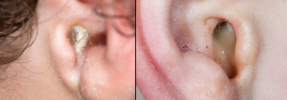 Zweimal Eiter, zwei verschiedene Krankheitsbilder: Während der Junge im linken Bild unter einer Otitis externa leidet, kommt die Flüssigkeit beim 2-Jährigen im rechten Bild aus dem Mittelohr (Otitis media mit Trommelfellperforation).