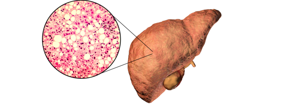 Die Inzidenz von Todesfällen und anderen Outcomes verglichen die Forscher über alle histologischen Ausgangswerte hinweg. 