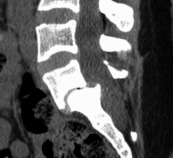 In der Computertomographie zeigt sich eine Spondylolisthesis zwischen L5 und S1.