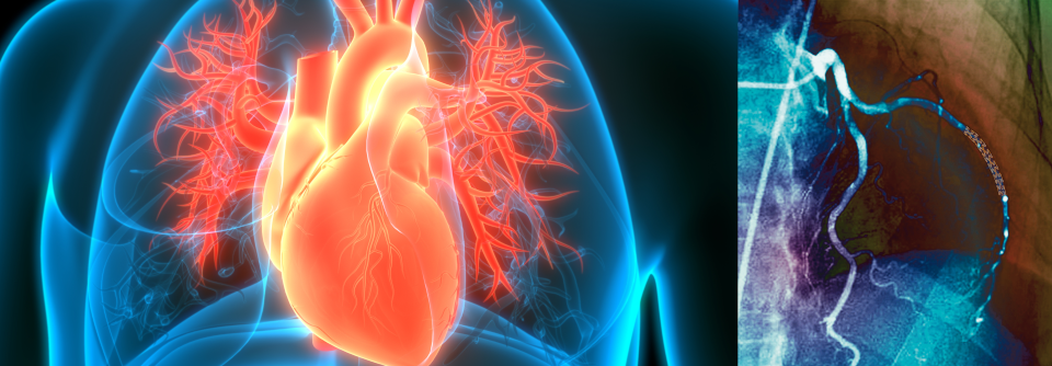 Bei Angina pectoris scheint vielen der Stent das Nonplusultra. Bevor man dazu greift, sollten aber erst alle medikamentösen Optionen ausgeschöpft werden.
