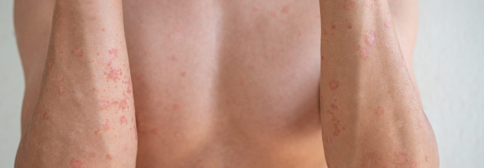 Die Haut von Kindern mit atopischer Dermatitis weist einen niedrigeren Natural Moisturizing Factors (NMF)-Gehalt auf.