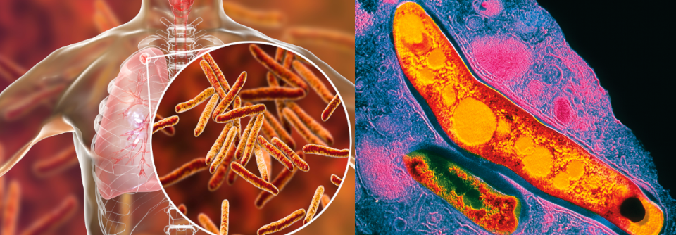 Rechts im Bild: Mycobacterium tuberculosis (kolorierte Aufnahme mittels Transmissions-Elektronen-Mikroskopie).