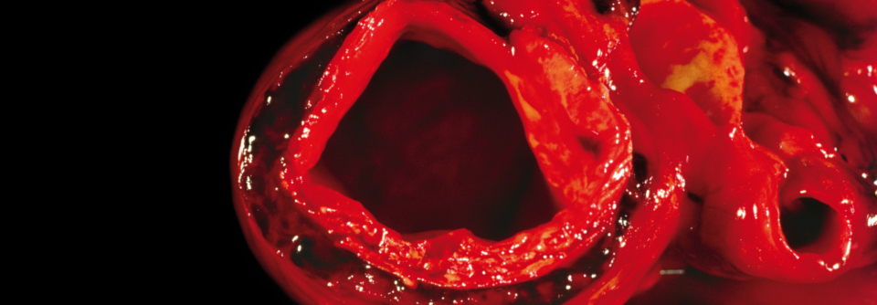 Eine lebenslange Überwachung mit jährlichen CT-Untersuchungen ist bei einer Aortendissketion unabdingbar.