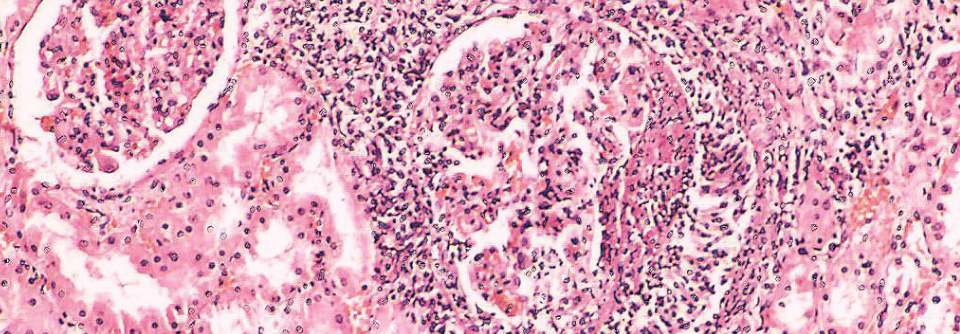 Da bei extrapulmonaler Tuberkulose das Negativwerden des Sputums als Monitoringfaktor ungeeignet ist, müssen Klinik und ggf. die Bildgebung zur Beurteilung des Therapieeffektes herangezogen werden.