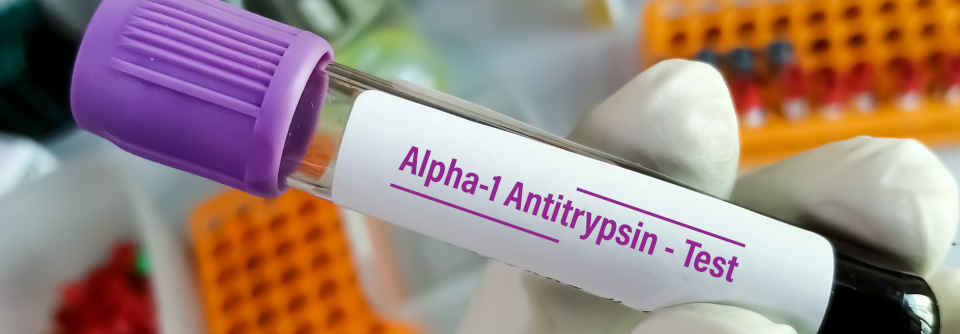 Schwerer Alpha-1-Antitrypsin-Mangel erhöht das Krebsrisiko.