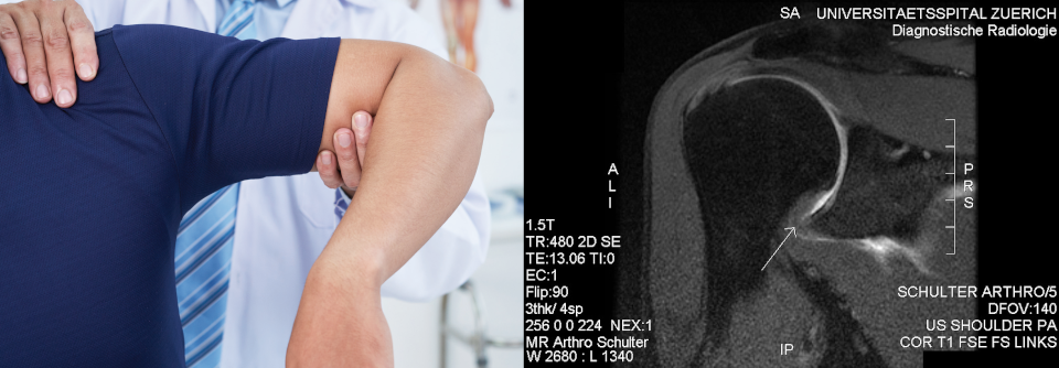 Bei der Frozen Shoulder verdickt die Gelenkkapsel am Recessus axillaris (links). Die Physiotherapie muss an den Verlauf angepasst werden: Dehnübungen sind ab der adhäsiven Phase erlaubt, Krafttraining gegen Widerstand ab der Auflösungsphase.