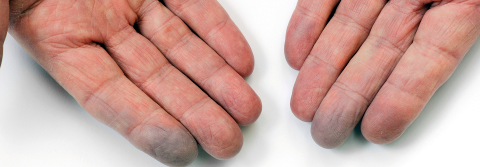 Beim Rynaud-Syndrom verkrampft anfallsartig die Muskulatur in den Arterien und Arteriolen in den Händen oder Füßen.