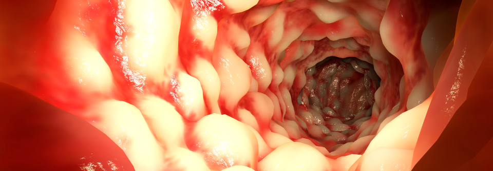 Nur CED-Patienten ohne aktive Erkrankung nahmen an der Studie teil, obwohl ein Effekt eher bei fortbestehender Inflammation zu erwarten ist.