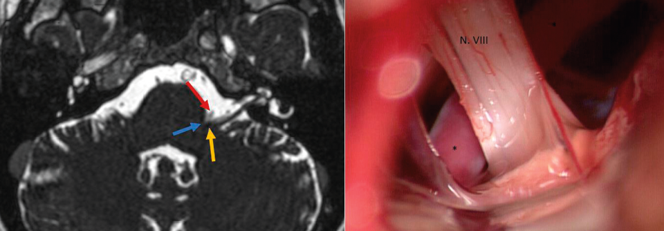 Li.: Im MRT stellt sich der Konflikt (blauer Pfeil) zwischen A. cerebelli inferior anterior (rot) und dem N. vestibulocochlearis (gelb) gut dar.

Re.: Intraoperativer Situs vor dem Abpräparieren der vorderen Kleinhirnarterie von den Nerven.