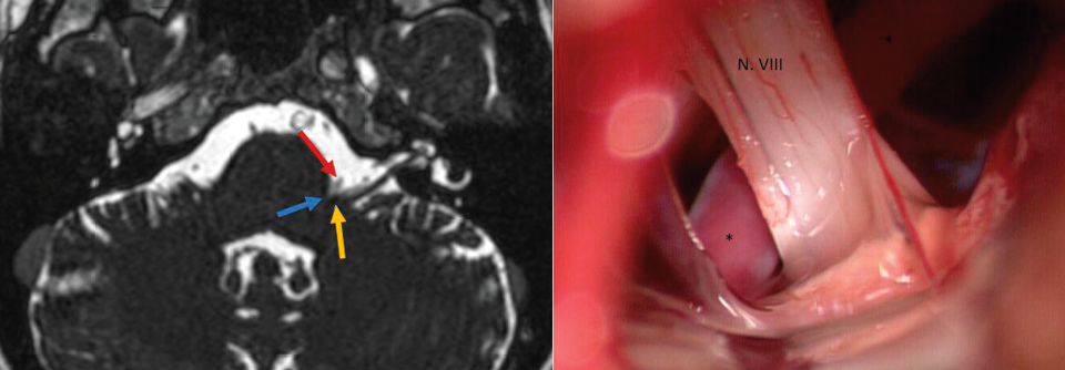 Li.: Im MRT stellt sich der Konflikt (blauer Pfeil) zwischen A. cerebelli inferior anterior (rot) und dem N. vestibulocochlearis (gelb) gut dar.

Re.: Intraoperativer Situs vor dem Abpräparieren der vorderen Kleinhirnarterie von den Nerven.