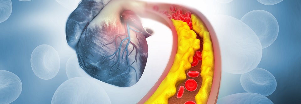 Kardiovaskuläre Endpunktstudien sollten auch für Typ-1-Diabetes durchgeführt werden.