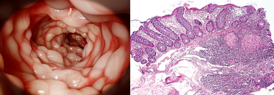Bei diesem Crohn-Patienten finden sich submukosal lymphoide Aggregate und Granulome.