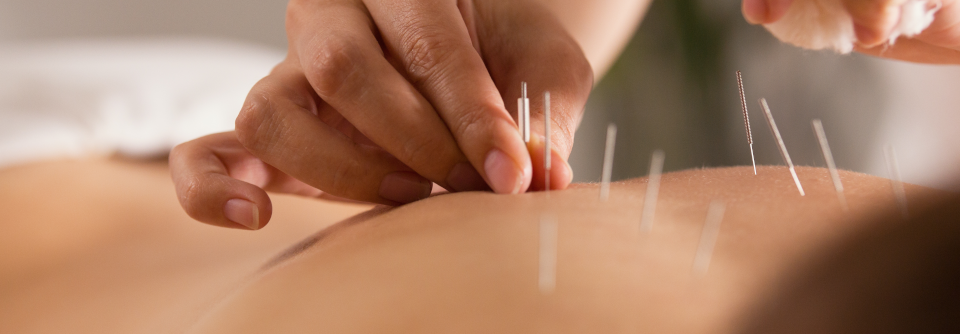 Klassische Akupunktur konnte die Schmerzen 40 Wochen über das Therapieende hinaus signifikant reduzieren.