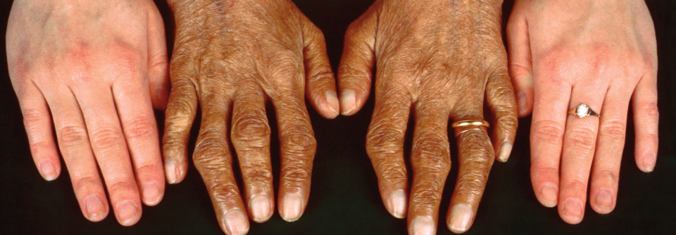 Hyperpigmentierung und arthritische Deformierungen: zwei typische Kennzeichen der Hämochromatose.