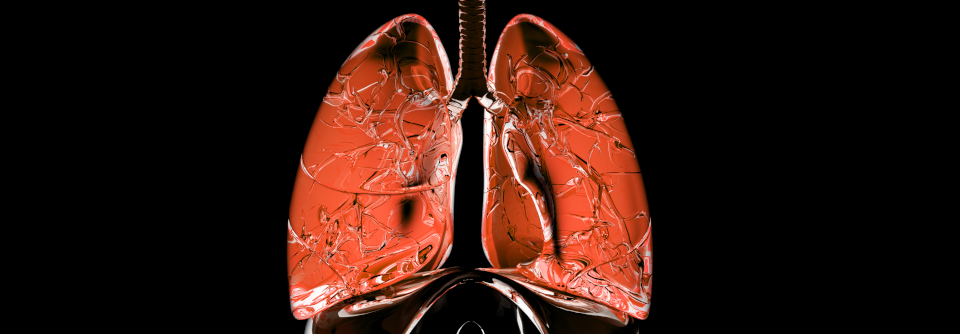 Innerhalb von fünf Jahren nach Diagnosestellung einer idiopathischen Lungenfibrose haben zwar 52 % der Betroffenen eine Langzeitsauerstofftherapie erhalten, aber nur 11,6 % eine antifibrotische Behandlung.