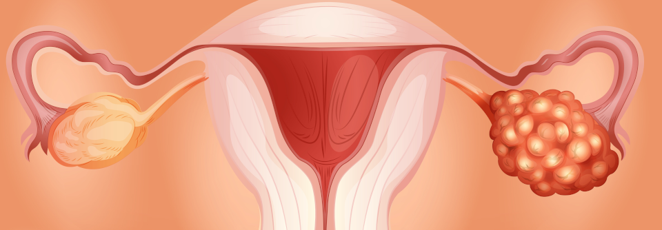 Frauen, die schlecht auf die Krebsbehandlung ansprachen, waren auffallend dicht mit den fraglichen Mikroorganismen besiedelt.