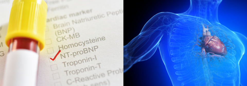 Herzinsuffizienz: Serielle Messungen von NT-proBNP sind besonders aussagekräftig NT-proBNP ist ein Fragment von BNP, das bei Volumenbelastung der Kammern von den Myokardzellen freigesetzt wird.