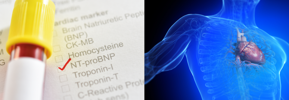 NT-proBNP ist ein Fragment von BNP, das bei Volumenbelastung der Kammern von den Myokardzellen freigesetzt wird.