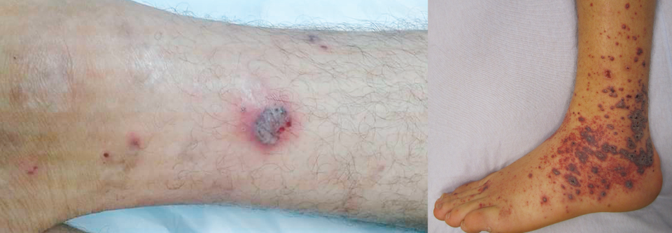 Unterschenkel eines Patienten mit medikamenteninduzierter Vaskulitis. Deutlich zu sehen sind die kleinen Hauteinblutungen sowie eine Purpura.

Die Läsionen bei Patienten mit einer Vaskulitis beginnen meist an den Beinen und breiten sich von dort nach proximal aus.