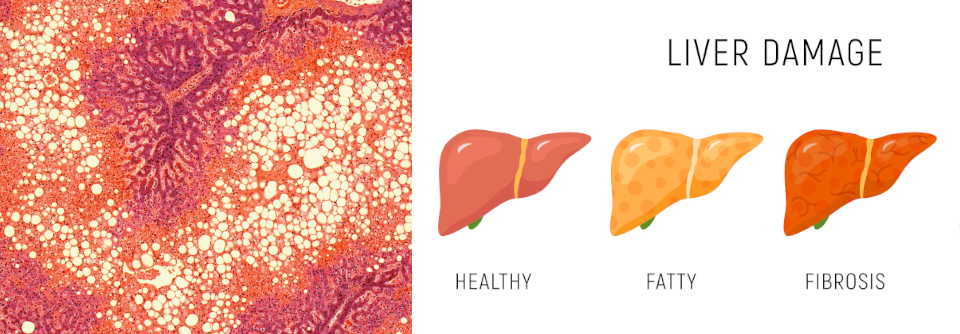 Bei Patienten mit hepatischer Steatose lagern die Leberzellen vermehrt Fett (hellgelb) ein.