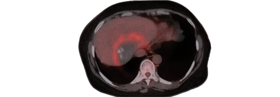 Bei diesem 45-Jährigen mit hepatischer alveolärer Echinokokkose stellt sich die halbkreisförmige Läsion im PET-CT als stoffwechselaktiv heraus.