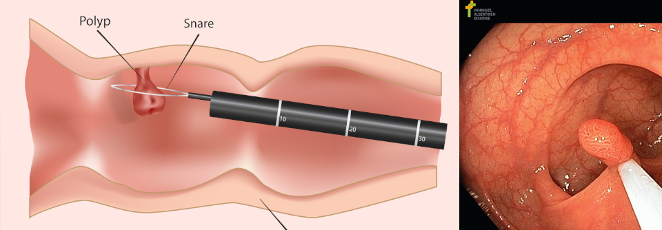 In den meisten Fällen lassen sich die Polypen bei der ersten Sitzung entfernen.