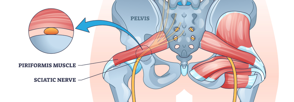 Botulinumtoxin lähmt den Piriformis und der Druck auf den Ischiasnerv lässt nach.