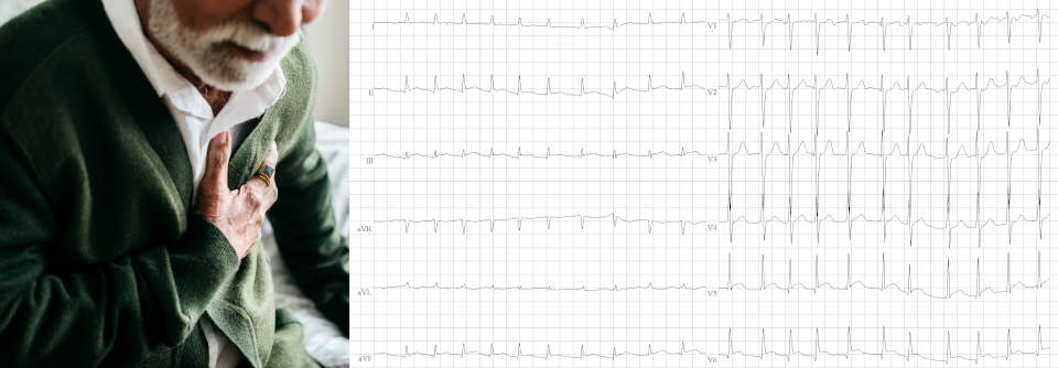 Zu den Rhythmusstörungen, die im Alter häufiger auftreten, gehört das Bradykardie-Tachykardie-Syndrom.