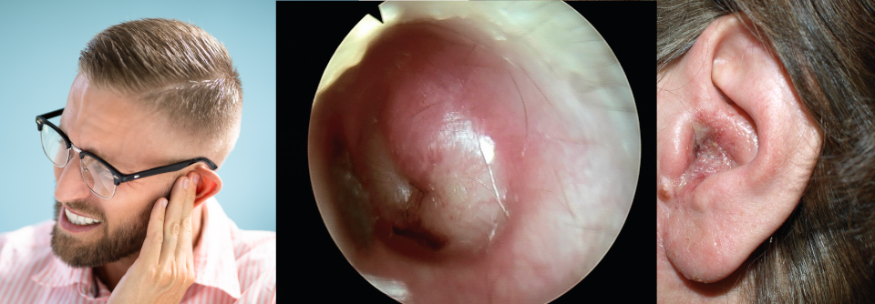 Otitis extern: Tipps vom Experten für die Therapie Meist ist eine entzündliche Schwellung des äußeren Gehörgangs bakteriell bedingt, Pilzinfektionen werden jedoch häufiger (Mitte).
Droht das Trommelfell zu reißen, sollte man mit der Antibiose nicht zögern (rechts).