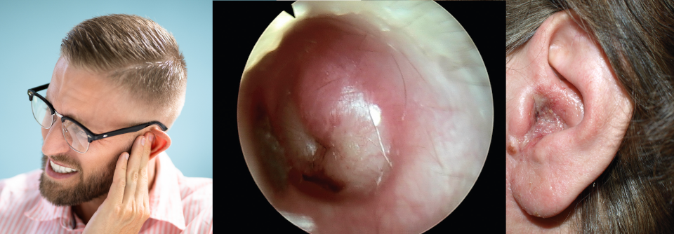 Meist ist eine entzündliche Schwellung des äußeren Gehörgangs bakteriell bedingt, Pilzinfektionen werden jedoch häufiger (Mitte).
Droht das Trommelfell zu reißen, sollte man mit der Antibiose nicht zögern (rechts).