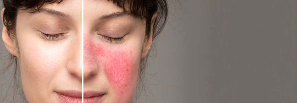 In vielen Fällen braucht es gar keinen Dermatologen, um Gesichtsdermatosen richtig einzuordnen