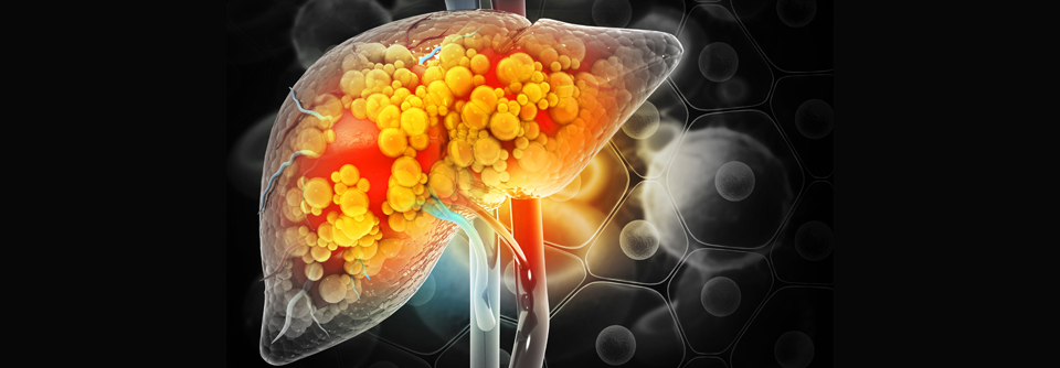 „Metabolic Dysfunction-associated Steatotic Liver Disease“ (MASLD) und „Metabolic Dysfunction-associated Steatohepatitis“ (MASH) ersetzen die alten Begriffe „Nonalcoholic Fatty Liver Disease“ (NAFLD) und „Nonalcoholic Fatty Liver Disease“ (NAFLD).