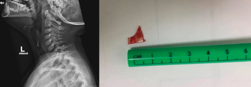 Links: Die Röntgenaufnahme des Halses im posterioranterioren Strahlengang zeigt den Fremdkörper deutlich.
Rechts: Diese Scherbe steckte dem Kind ein Jahr lang im Hals