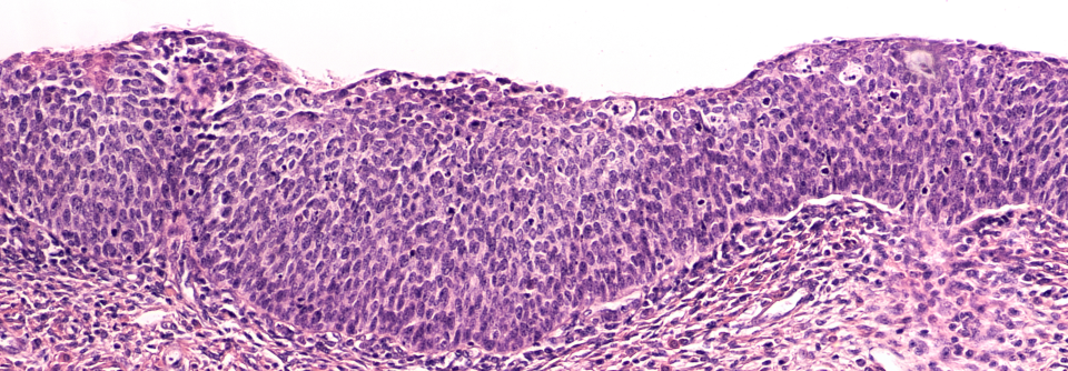 Die Impfeffektivität lag auch nach drei Jahren und mehr bei mindestens 51 %. Sie kommen zu dem Schluss, dass immunkompetente Frauen von der dreimaligen postoperativen HPV-Impfung klar profitieren.