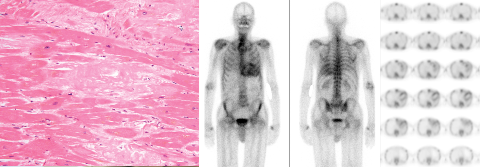 Bild 1: Die extrazellulären, „schaumigen“ Amyloidablagerungen im Herzmuskel sind unterm Mikroskop gut zu erkennen (hellrosa).

Bild 2: Mithilfe der Knochenszintigrafie lässt sich die kardiale ATTR-Amyloidose mit hoher Sicherheit nicht-invasiv nachweisen.