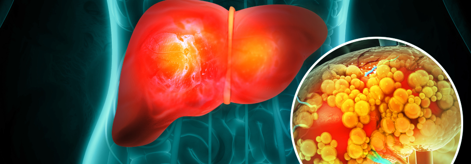 Eine Beeinträchtigung des Glukose- und Lipidstoffwechsels begünstigt die NAFLD.