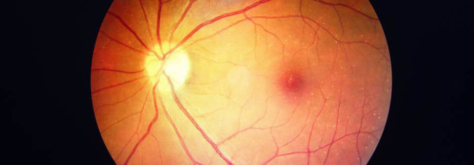 Auf der Basis elektronischer Krankenakten hatten die Wissenschaftler die Outcomes von Betroffenen mit retinalem Verschluss mit den Ergebnissen von Patienten mit Grauem Star verglichen.