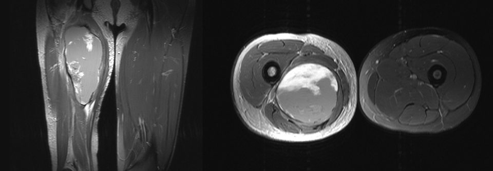 Links: In der MRT mit Kontrastmittelgabe fanden sich im Tumor inhomogene Areale, was auf eine ungleichmäßige Vaskularisation der Geschwulst und nekrotische Nester hinweist.
Rechts: Die benachbarte Muskulatur war unauffällig, der Femur intakt. Damit konnten die Ärzte ein Rhabdomyosarkom und ein Osteosarkom ausschließen.